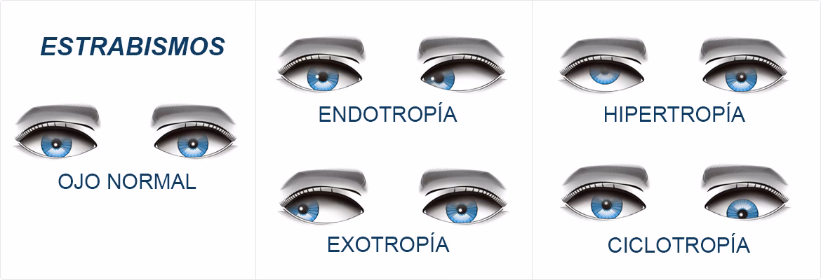¿Cuánto cuesta una operación de estrabismo en dólares?